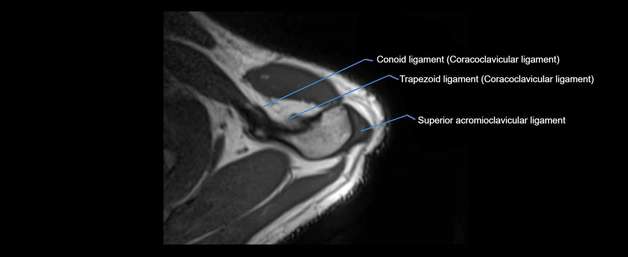 shoulder ligaments axial 3d 3t mri image-img-00005-00021.webp